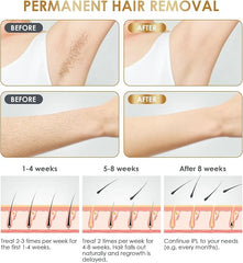 Laser Hair Removal